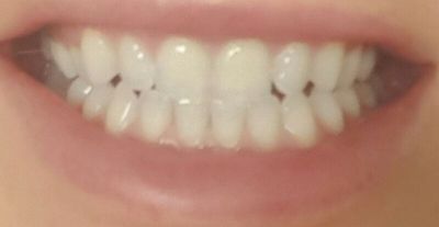 wybielanie zębów; wrażliwość; białe zęby; stomatologia; dentysta; zęby; wybielanie zębów; wrażliwość; białe zęby; stomatologia; dentysta; zęby;